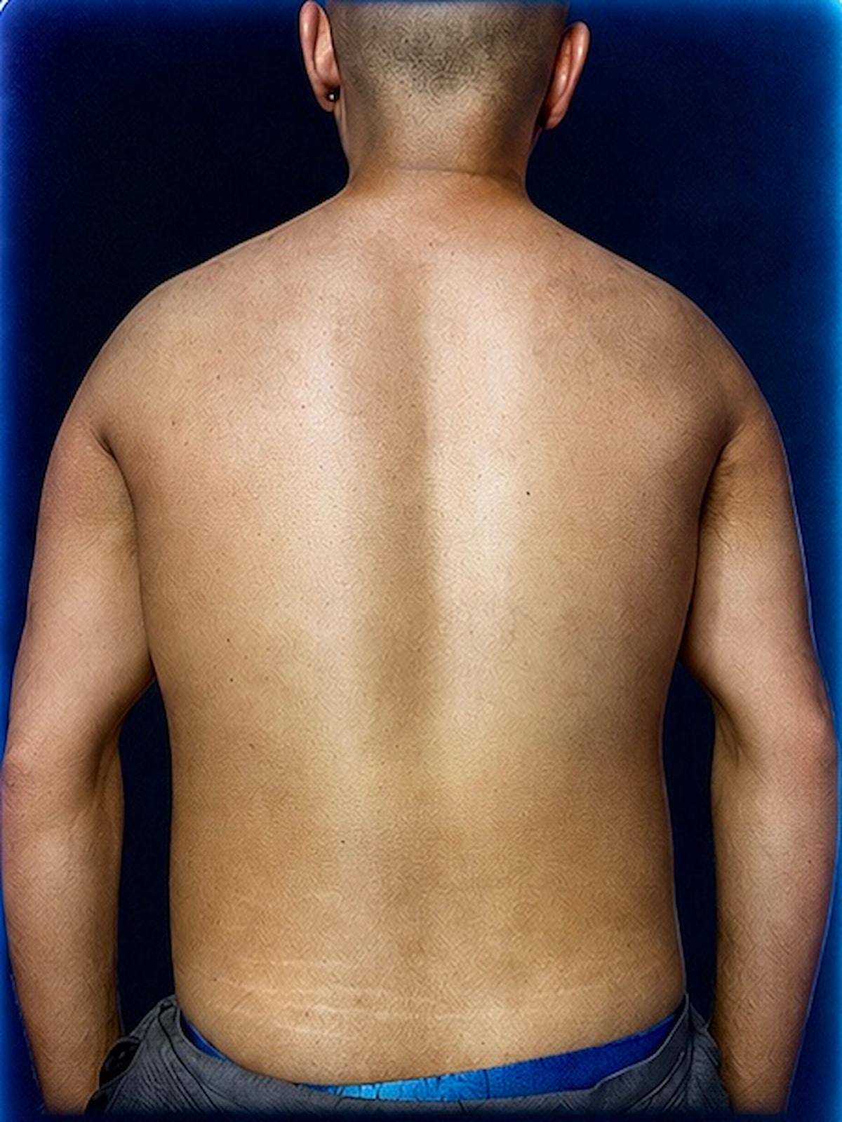 Men’s back waxing and body hair removal treatment result at Damon Spa Studio For Men in Vancouver.